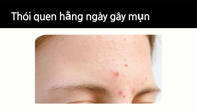 Thói quen hàng ngày gây mụn ít ai ngờ