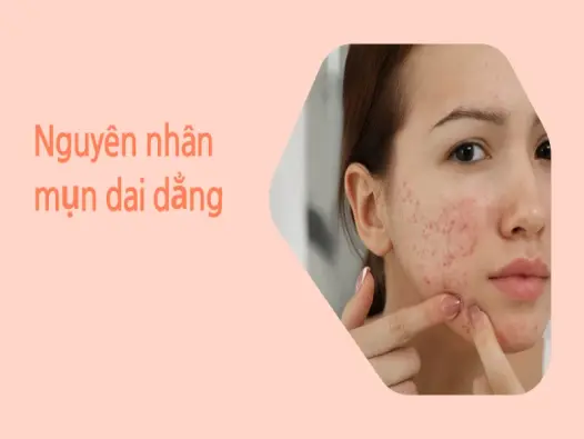 Nguyên nhân khiến da bị mụn kéo dài và cách xử lý hiệu quả
