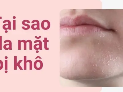 Tại sao da mặt bị khô dù bạn uống rất nhiều nước? Giải đáp