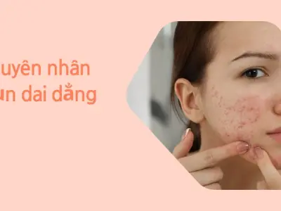 Nguyên nhân khiến da bị mụn kéo dài và cách xử lý hiệu quả